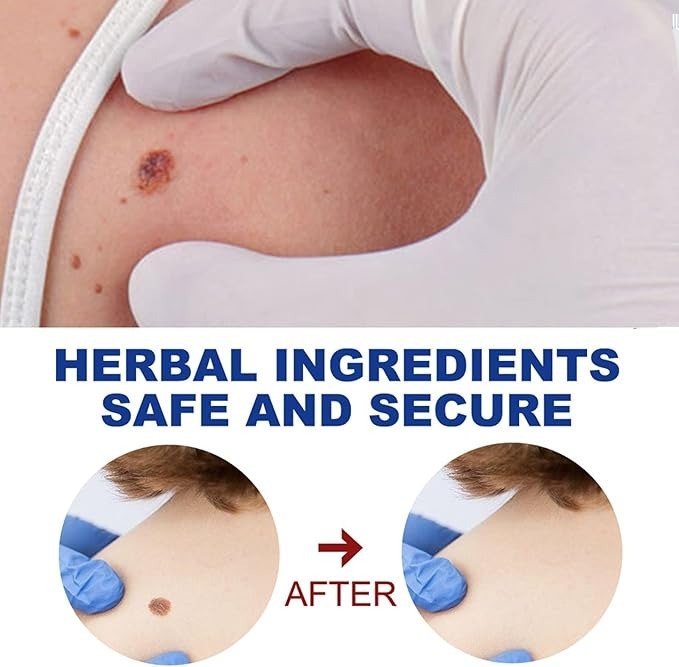 Sumifun Herbal Skin Ointment for Warts & Moles - Image 7